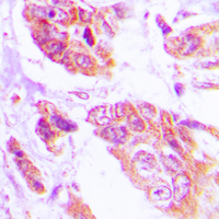 Immunohistochemical analysis of NGEP staining in human lung cancer formalin fixed paraffin embedded tissue section. The section was pre-treated using heat mediated antigen retrieval with sodium citrate buffer (pH 6.0). The section was then incubated with the antibody at room temperature and detected using an HRP conjugated compact polymer system. DAB was used as the chromogen. The section was then counterstained with haematoxylin and mounted with DPX.