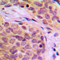 Immunohistochemical analysis of HSPA14 staining in human breast cancer formalin fixed paraffin embedded tissue section. The section was pre-treated using heat mediated antigen retrieval with sodium citrate buffer (pH 6.0). The section was then incubated with the antibody at room temperature and detected using an HRP conjugated compact polymer system. DAB was used as the chromogen. The section was then counterstained with haematoxylin and mounted with DPX.