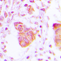 Immunohistochemical analysis of MOV10L1 staining in human lung cancer formalin fixed paraffin embedded tissue section. The section was pre-treated using heat mediated antigen retrieval with sodium citrate buffer (pH 6.0). The section was then incubated with the antibody at room temperature and detected using an HRP conjugated compact polymer system. DAB was used as the chromogen. The section was then counterstained with haematoxylin and mounted with DPX.