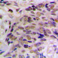 Immunohistochemical analysis of HES6 staining in human prostate cancer formalin fixed paraffin embedded tissue section. The section was pre-treated using heat mediated antigen retrieval with sodium citrate buffer (pH 6.0). The section was then incubated with the antibody at room temperature and detected using an HRP conjugated compact polymer system. DAB was used as the chromogen. The section was then counterstained with haematoxylin and mounted with DPX.