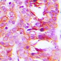 Immunohistochemical analysis of KCNK15 staining in human breast cancer formalin fixed paraffin embedded tissue section. The section was pre-treated using heat mediated antigen retrieval with sodium citrate buffer (pH 6.0). The section was then incubated with the antibody at room temperature and detected using an HRP conjugated compact polymer system. DAB was used as the chromogen. The section was then counterstained with haematoxylin and mounted with DPX.