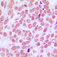 Immunohistochemical analysis of CCDC102B staining in human breast cancer formalin fixed paraffin embedded tissue section. The section was pre-treated using heat mediated antigen retrieval with sodium citrate buffer (pH 6.0). The section was then incubated with the antibody at room temperature and detected using an HRP conjugated compact polymer system. DAB was used as the chromogen. The section was then counterstained with haematoxylin and mounted with DPX.