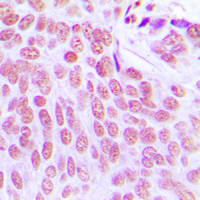 Immunohistochemical analysis of ITPKC staining in human breast cancer formalin fixed paraffin embedded tissue section. The section was pre-treated using heat mediated antigen retrieval with sodium citrate buffer (pH 6.0). The section was then incubated with the antibody at room temperature and detected using an HRP conjugated compact polymer system. DAB was used as the chromogen. The section was then counterstained with haematoxylin and mounted with DPX.