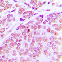 Immunohistochemical analysis of CEP70 staining in human breast cancer formalin fixed paraffin embedded tissue section. The section was pre-treated using heat mediated antigen retrieval with sodium citrate buffer (pH 6.0). The section was then incubated with the antibody at room temperature and detected using an HRP conjugated compact polymer system. DAB was used as the chromogen. The section was then counterstained with haematoxylin and mounted with DPX.