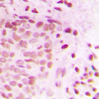 Immunohistochemical analysis of ATRIP staining in human breast cancer formalin fixed paraffin embedded tissue section. The section was pre-treated using heat mediated antigen retrieval with sodium citrate buffer (pH 6.0). The section was then incubated with the antibody at room temperature and detected using an HRP conjugated compact polymer system. DAB was used as the chromogen. The section was then counterstained with haematoxylin and mounted with DPX.