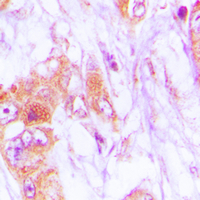 Immunohistochemical analysis of CDKL4 staining in human lung cancer formalin fixed paraffin embedded tissue section. The section was pre-treated using heat mediated antigen retrieval with sodium citrate buffer (pH 6.0). The section was then incubated with the antibody at room temperature and detected using an HRP conjugated compact polymer system. DAB was used as the chromogen. The section was then counterstained with haematoxylin and mounted with DPX.
