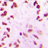 Immunohistochemical analysis of CLK2 staining in human lung cancer formalin fixed paraffin embedded tissue section. The section was pre-treated using heat mediated antigen retrieval with sodium citrate buffer (pH 6.0). The section was then incubated with the antibody at room temperature and detected using an HRP conjugated compact polymer system. DAB was used as the chromogen. The section was then counterstained with haematoxylin and mounted with DPX.