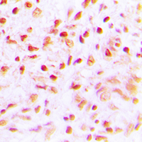 Immunohistochemical analysis of SENP6 staining in human lung cancer formalin fixed paraffin embedded tissue section. The section was pre-treated using heat mediated antigen retrieval with sodium citrate buffer (pH 6.0). The section was then incubated with the antibody at room temperature and detected using an HRP conjugad compact polymer system. DAB was used as the chromogen. The section was then counterstained with haematoxylin and mounted with DPX. w