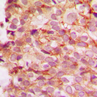 Immunohistochemical analysis of Collagen 4 alpha 1 staining in human breast cancer formalin fixed paraffin embedded tissue section. The section was pre-treated using heat mediated antigen retrieval with sodium citrate buffer (pH 6.0). The section was then incubated with the antibody at room temperature and detected using an HRP conjugated compact polymer system. DAB was used as the chromogen. The section was then counterstained with haematoxylin and mounted with DPX.