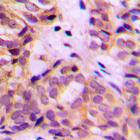 Immunohistochemical analysis of ALDH1A2 staining in human breast cancer formalin fixed paraffin embedded tissue section. The section was pre-treated using heat mediated antigen retrieval with sodium citrate buffer (pH 6.0). The section was then incubated with the antibody at room temperature and detected using an HRP conjugad compact polymer system. DAB was used as the chromogen. The section was then counterstained with haematoxylin and mounted with DPX. w