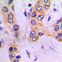 Immunohistochemical analysis of ALDH3B1 staining in human lung cancer formalin fixed paraffin embedded tissue section. The section was pre-treated using heat mediated antigen retrieval with sodium citrate buffer (pH 6.0). The section was then incubated with the antibody at room temperature and detected using an HRP conjugad compact polymer system. DAB was used as the chromogen. The section was then counterstained with haematoxylin and mounted with DPX. w