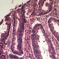 Immunohistochemical analysis of Apolipoprotein L3 staining in human colon cancer formalin fixed paraffin embedded tissue section. The section was pre-treated using heat mediated antigen retrieval with sodium citrate buffer (pH 6.0). The section was then incubated with the antibody at room temperature and detected using an HRP conjugad compact polymer system. DAB was used as the chromogen. The section was then counterstained with haematoxylin and mounted with DPX. w