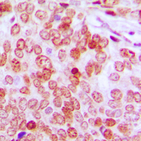 Immunohistochemical analysis of ATF5 staining in human prostate cancer formalin fixed paraffin embedded tissue section. The section was pre-treated using heat mediated antigen retrieval with sodium citrate buffer (pH 6.0). The section was then incubated with the antibody at room temperature and detected using an HRP conjugad compact polymer system. DAB was used as the chromogen. The section was then counterstained with haematoxylin and mounted with DPX. w
