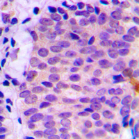 Immunohistochemical analysis of ATG4C staining in human prostate cancer formalin fixed paraffin embedded tissue section. The section was pre-treated using heat mediated antigen retrieval with sodium citrate buffer (pH 6.0). The section was then incubated with the antibody at room temperature and detected using an HRP conjugad compact polymer system. DAB was used as the chromogen. The section was then counterstained with haematoxylin and mounted with DPX. w