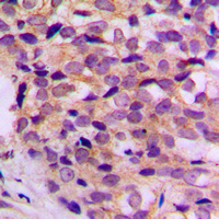 Immunohistochemical analysis of ATP5G1 staining in human breast cancer formalin fixed paraffin embedded tissue section. The section was pre-treated using heat mediated antigen retrieval with sodium citrate buffer (pH 6.0). The section was then incubated with the antibody at room temperature and detected using an HRP conjugad compact polymer system. DAB was used as the chromogen. The section was then counterstained with haematoxylin and mounted with DPX. w