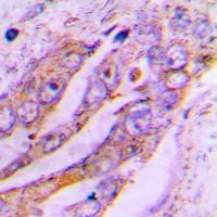 Immunohistochemical analysis of ATP5JL staining in human lung cancer formalin fixed paraffin embedded tissue section. The section was pre-treated using heat mediated antigen retrieval with sodium citrate buffer (pH 6.0). The section was then incubated with the antibody at room temperature and detected using an HRP conjugad compact polymer system. DAB was used as the chromogen. The section was then counterstained with haematoxylin and mounted with DPX. w