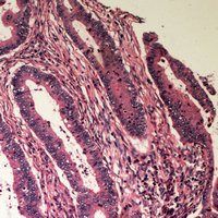 Immunohistochemical analysis of B4GALT2 staining in human colon cancer formalin fixed paraffin embedded tissue section. The section was pre-treated using heat mediated antigen retrieval with sodium citrate buffer (pH 6.0). The section was then incubated with the antibody at room temperature and detected using an HRP conjugad compact polymer system. DAB was used as the chromogen. The section was then counterstained with haematoxylin and mounted with DPX. w