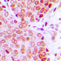Immunohistochemical analysis of ZNF134 staining in human prostate cancer formalin fixed paraffin embedded tissue section. The section was pre-treated using heat mediated antigen retrieval with sodium citrate buffer (pH 6.0). The section was then incubated with the antibody at room temperature and detected using an HRP conjugad compact polymer system. DAB was used as the chromogen. The section was then counterstained with haematoxylin and mounted with DPX. w