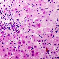 Immunohistochemical analysis of CEP110 staining in human liver cancer formalin fixed paraffin embedded tissue section. The section was pre-treated using heat mediated antigen retrieval with sodium citrate buffer (pH 6.0). The section was then incubated with the antibody at room temperature and detected using an HRP conjugad compact polymer system. DAB was used as the chromogen. The section was then counterstained with haematoxylin and mounted with DPX. w