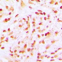 Immunohistochemical analysis of CDC16 staining in human lung cancer formalin fixed paraffin embedded tissue section. The section was pre-treated using heat mediated antigen retrieval with sodium citrate buffer (pH 6.0). The section was then incubated with the antibody at room temperature and detected using an HRP conjugad compact polymer system. DAB was used as the chromogen. The section was then counterstained with haematoxylin and mounted with DPX. w