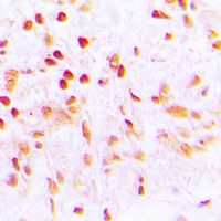 Immunohistochemical analysis of CDCA2 staining in human lung cancer formalin fixed paraffin embedded tissue section. The section was pre-treated using heat mediated antigen retrieval with sodium citrate buffer (pH 6.0). The section was then incubated with the antibody at room temperature and detected using an HRP conjugad compact polymer system. DAB was used as the chromogen. The section was then counterstained with haematoxylin and mounted with DPX. w