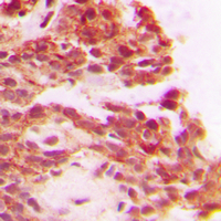 Immunohistochemical analysis of Carboxypeptidase A1 staining in human breast cancer formalin fixed paraffin embedded tissue section. The section was pre-treated using heat mediated antigen retrieval with sodium citrate buffer (pH 6.0). The section was then incubated with the antibody at room temperature and detected using an HRP conjugated compact polymer system. DAB was used as the chromogen. The section was then counterstained with haematoxylin and mounted with DPX.
