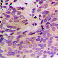 Immunohistochemical analysis of CERKL staining in human prostate cancer formalin fixed paraffin embedded tissue section. The section was pre-treated using heat mediated antigen retrieval with sodium citrate buffer (pH 6.0). The section was then incubated with the antibody at room temperature and detected using an HRP conjugad compact polymer system. DAB was used as the chromogen. The section was then counterstained with haematoxylin and mounted with DPX. w