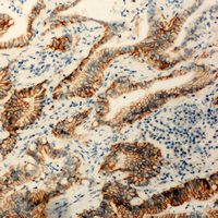Immunohistochemical analysis of Claudin 3 staining in human colon cancer formalin fixed paraffin embedded tissue section. The section was pre-treated using heat mediated antigen retrieval with sodium citrate buffer (pH 6.0). The section was then incubated with the antibody at room temperature and detected using an HRP conjugad compact polymer system. DAB was used as the chromogen. The section was then counterstained with haematoxylin and mounted with DPX. w