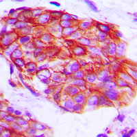 Immunohistochemical analysis of Claudin 6 staining in human prostate cancer formalin fixed paraffin embedded tissue section. The section was pre-treated using heat mediated antigen retrieval with sodium citrate buffer (pH 6.0). The section was then incubated with the antibody at room temperature and detected using an HRP conjugad compact polymer system. DAB was used as the chromogen. The section was then counterstained with haematoxylin and mounted with DPX. w