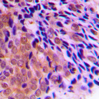 Immunohistochemical analysis of CLOCK staining in human prostate cancer formalin fixed paraffin embedded tissue section. The section was pre-treated using heat mediated antigen retrieval with sodium citrate buffer (pH 6.0). The section was then incubated with the antibody at room temperature and detected using an HRP conjugad compact polymer system. DAB was used as the chromogen. The section was then counterstained with haematoxylin and mounted with DPX. w