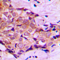 Immunohistochemical analysis of DNAL4 staining in human breast cancer formalin fixed paraffin embedded tissue section. The section was pre-treated using heat mediated antigen retrieval with sodium citrate buffer (pH 6.0). The section was then incubated with the antibody at room temperature and detected using an HRP conjugad compact polymer system. DAB was used as the chromogen. The section was then counterstained with haematoxylin and mounted with DPX.