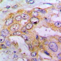 Immunohistochemical analysis of EIF4G1 (pS1148) staining in human lung cancer formalin fixed paraffin embedded tissue section. The section was pre-treated using heat mediated antigen retrieval with sodium citrate buffer (pH 6.0). The section was then incubated with the antibody at room temperature and detected using an HRP conjugad compact polymer system. DAB was used as the chromogen. The section was then counterstained with haematoxylin and mounted with DPX.