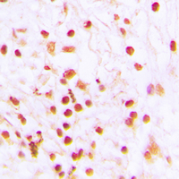Immunohistochemical analysis of ERCC6 staining in human lung cancer formalin fixed paraffin embedded tissue section. The section was pre-treated using heat mediated antigen retrieval with sodium citrate buffer (pH 6.0). The section was then incubated with the antibody at room temperature and detected using an HRP conjugad compact polymer system. DAB was used as the chromogen. The section was then counterstained with haematoxylin and mounted with DPX.