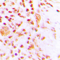 Immunohistochemical analysis of ETV4 staining in human lung cancer formalin fixed paraffin embedded tissue section. The section was pre-treated using heat mediated antigen retrieval with sodium citrate buffer (pH 6.0). The section was then incubated with the antibody at room temperature and detected using an HRP conjugad compact polymer system. DAB was used as the chromogen. The section was then counterstained with haematoxylin and mounted with DPX.