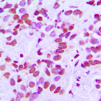 Immunohistochemical analysis of CANP staining in human breast cancer formalin fixed paraffin embedded tissue section. The section was pre-treated using heat mediated antigen retrieval with sodium citrate buffer (pH 6.0). The section was then incubated with the antibody at room temperature and detected using an HRP conjugad compact polymer system. DAB was used as the chromogen. The section was then counterstained with haematoxylin and mounted with DPX.