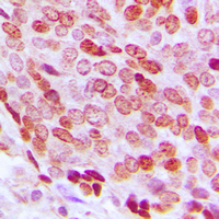 Immunohistochemical analysis of FOXD3 staining in human prostate cancer formalin fixed paraffin embedded tissue section. The section was pre-treated using heat mediated antigen retrieval with sodium citrate buffer (pH 6.0). The section was then incubated with the antibody at room temperature and detected using an HRP conjugad compact polymer system. DAB was used as the chromogen. The section was then counterstained with haematoxylin and mounted with DPX.