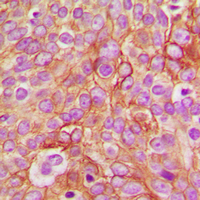 Immunohistochemical analysis of GABRB1 (pS434) staining in human breast cancer formalin fixed paraffin embedded tissue section. The section was pre-treated using heat mediated antigen retrieval with sodium citrate buffer (pH 6.0). The section was then incubated with the antibody at room temperature and detected using an HRP conjugad compact polymer system. DAB was used as the chromogen. The section was then counterstained with haematoxylin and mounted with DPX.