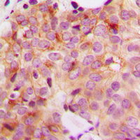 Immunohistochemical analysis of GAK staining in human breast cancer formalin fixed paraffin embedded tissue section. The section was pre-treated using heat mediated antigen retrieval with sodium citrate buffer (pH 6.0). The section was then incubated with the antibody at room temperature and detected using an HRP conjugad compact polymer system. DAB was used as the chromogen. The section was then counterstained with haematoxylin and mounted with DPX.