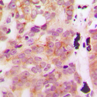 Immunohistochemical analysis of GLB1L3 staining in human breast cancer formalin fixed paraffin embedded tissue section. The section was pre-treated using heat mediated antigen retrieval with sodium citrate buffer (pH 6.0). The section was then incubated with the antibody at room temperature and detected using an HRP conjugad compact polymer system. DAB was used as the chromogen. The section was then counterstained with haematoxylin and mounted with DPX.
