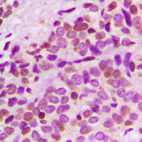 Immunohistochemical analysis of GNL3L staining in human breast cancer formalin fixed paraffin embedded tissue section. The section was pre-treated using heat mediated antigen retrieval with sodium citrate buffer (pH 6.0). The section was then incubated with the antibody at room temperature and detected using an HRP conjugad compact polymer system. DAB was used as the chromogen. The section was then counterstained with haematoxylin and mounted with DPX.