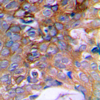 Immunohistochemical analysis of HIBADH staining in human prostate cancer formalin fixed paraffin embedded tissue section. The section was pre-treated using heat mediated antigen retrieval with sodium citrate buffer (pH 6.0). The section was then incubated with the antibody at room temperature and detected using an HRP conjugad compact polymer system. DAB was used as the chromogen. The section was then counterstained with haematoxylin and mounted with DPX.