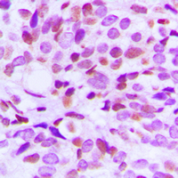 Immunohistochemical analysis of BRAF35 staining in human breast cancer formalin fixed paraffin embedded tissue section. The section was pre-treated using heat mediated antigen retrieval with sodium citrate buffer (pH 6.0). The section was then incubated with the antibody at room temperature and detected using an HRP conjugad compact polymer system. DAB was used as the chromogen. The section was then counterstained with haematoxylin and mounted with DPX.