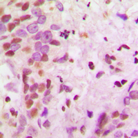 Immunohistochemical analysis of hnRNP A2/B1 staining in human breast cancer formalin fixed paraffin embedded tissue section. The section was pre-treated using heat mediated antigen retrieval with sodium citrate buffer (pH 6.0). The section was then incubated with the antibody at room temperature and detected using an HRP conjugad compact polymer system. DAB was used as the chromogen. The section was then counterstained with haematoxylin and mounted with DPX.