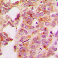 Immunohistochemical analysis of HSP70 staining in human breast cancer formalin fixed paraffin embedded tissue section. The section was pre-treated using heat mediated antigen retrieval with sodium citrate buffer (pH 6.0). The section was then incubated with the antibody at room temperature and detected using an HRP conjugad compact polymer system. DAB was used as the chromogen. The section was then counterstained with haematoxylin and mounted with DPX.