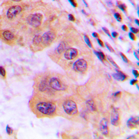 Immunohistochemical analysis of CTPS staining in human liver cancer formalin fixed paraffin embedded tissue section. The section was pre-treated using heat mediated antigen retrieval with sodium citrate buffer (pH 6.0). The section was then incubated with the antibody at room temperature and detected using an HRP conjugated compact polymer system. DAB was used as the chromogen. The section was then counterstained with haematoxylin and mounted with DPX.