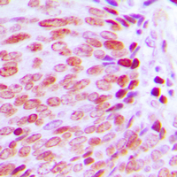 Immunohistochemical analysis of KLF10/11 staining in human prostate cancer formalin fixed paraffin embedded tissue section. The section was pre-treated using heat mediated antigen retrieval with sodium citrate buffer (pH 6.0). The section was then incubated with the antibody at room temperature and detected using an HRP conjugad compact polymer system. DAB was used as the chromogen. The section was then counterstained with haematoxylin and mounted with DPX.