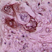 Immunohistochemical analysis of Laminin gamma 1 staining in human breast cancer formalin fixed paraffin embedded tissue section. The section was pre-treated using heat mediated antigen retrieval with sodium citrate buffer (pH 6.0). The section was then incubated with the antibody at room temperature and detected using an HRP conjugad compact polymer system. DAB was used as the chromogen. The section was then counterstained with haematoxylin and mounted with DPX.