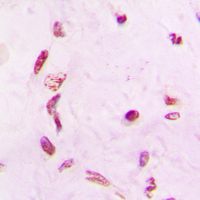 Immunohistochemical analysis of GW staining in human lung cancer formalin fixed paraffin embedded tissue section. The section was pre-treated using heat mediated antigen retrieval with sodium citrate buffer (pH 6.0). The section was then incubated with the antibody at room temperature and detected using an HRP conjugad compact polymer system. DAB was used as the chromogen. The section was then counterstained with haematoxylin and mounted with DPX.