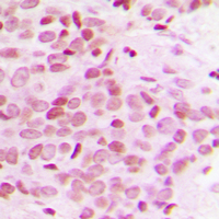 Immunohistochemical analysis of TRAP230 staining in human breast cancer formalin fixed paraffin embedded tissue section. The section was pre-treated using heat mediated antigen retrieval with sodium citrate buffer (pH 6.0). The section was then incubated with the antibody at room temperature and detected using an HRP conjugad compact polymer system. DAB was used as the chromogen. The section was then counterstained with haematoxylin and mounted with DPX.