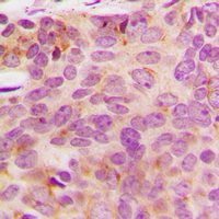 Immunohistochemical analysis of NDUFA3 staining in human breast cancer formalin fixed paraffin embedded tissue section. The section was pre-treated using heat mediated antigen retrieval with sodium citrate buffer (pH 6.0). The section was then incubated with the antibody at room temperature and detected using an HRP conjugad compact polymer system. DAB was used as the chromogen. The section was then counterstained with haematoxylin and mounted with DPX.